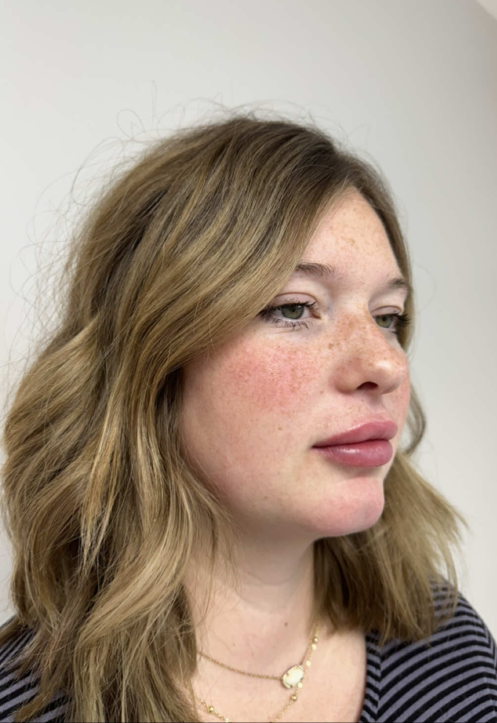 Fresh off the needle 💉👄 @collectiveperu #lips #lipfiller #prplipfiller #fyp