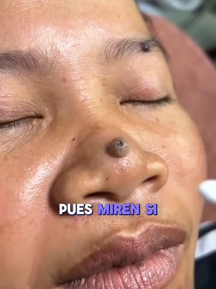 ¿Verrugas? ✋ ¡Dale click y cambia tu piel! ✨