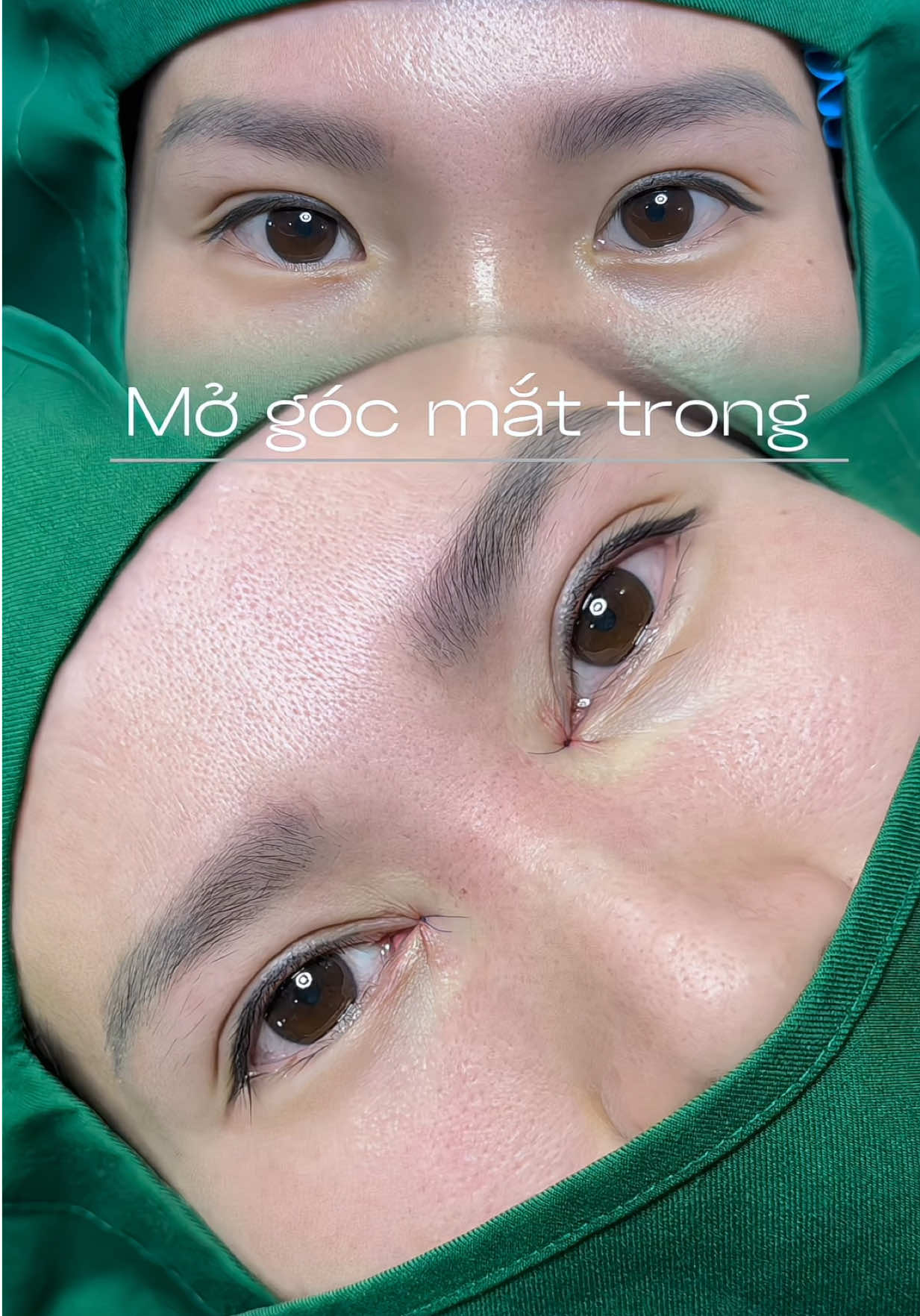 Mắt mở một chút, đáng yêu gấp mấy lần – công nhận “mở” đúng chỗ là xinh liền 🩷#lamdep #mogocmattrong #lamdepuytin #lamdepantoan #mogocmattrong 