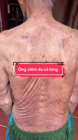 Nhìn ông bị viêm da cơ địa thương quá các bác ạ mong ông kiên trì sớm tan viêm da @Thị Tuyến DC 35(2) #vaynen #viêmdacơđịa 