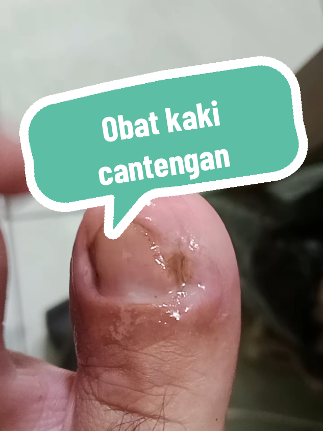 serum ini rekomendasi untuk merawat kaki bau, cantengan, kaki hitam, kaki bengkak #cantengan #kakibau #kakibernanah #kakibengkak #fyppppppppppppppppppppppp 