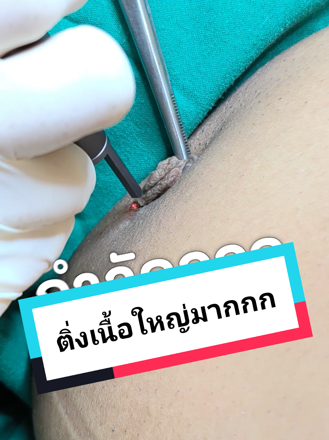 กำจัดติ่งเนื้อได้ทุกบริเวณ ด้วยการใช้ Co2 laser ปลอดภัย ไม่ทำลายเนื้อรอบๆ แผลสวย หายไว #ติ่งเนื้อ #กําจัดติ่งเนื้อ #ไฝ #จี้ไฝ  #กําจัดขี้แมลงวัน #เลเซอร์ไฝกับขี้แมลงวัน #เลเซอร์ติ่งเนื้อ 