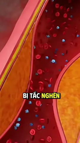 Khi mạch máu bị tắc nghẽn bởi mỡ thừa #thinhhanhtiktok #LearnOnTikTok #yhoccotruyen #xuhuong2025 