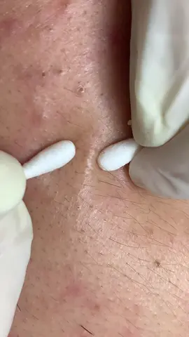 Xem đã luôn #nặnmụntămbôngBìnhDương #lohahouse #nanmunbinhduong #xuhuong 