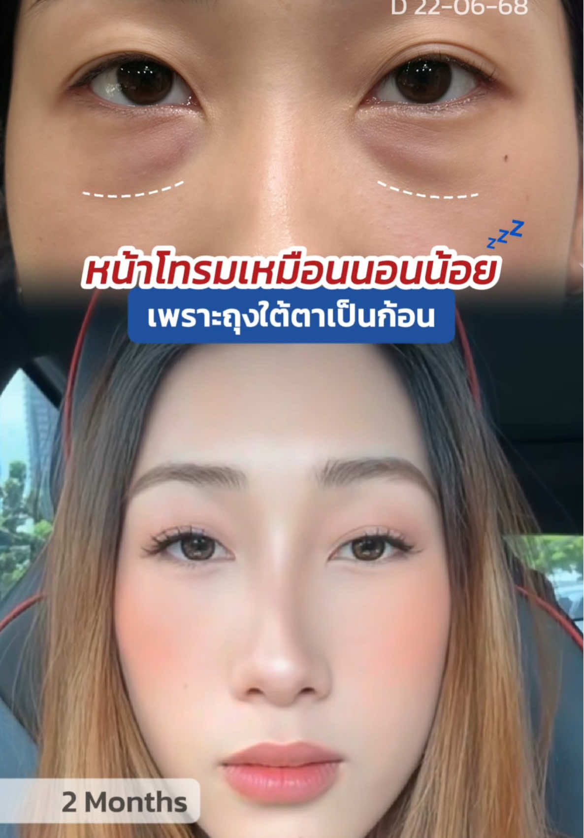 หน้าโทรมเหมือนนอนน้อย เพราะ #ถุงใต้ตา เป็นก้อน 😞 #skyclinic #กําจัดถุงใต้ตาแผลใน #ทีมแพทย์หมอสกาย #จักษุแพทย์ 