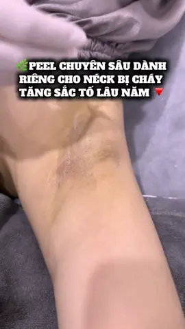 Da nách sáng mịn – tự tin diện áo hai dây! Liệu trình Peel chuyên sâu giúp giảm thâm, làm đều màu da rõ rệt 💫 #xuhuong #SpaUyTinTanPhu #LamBeautySpaTanPhu #PeelThâmNách #PeelTrịThâmMông 