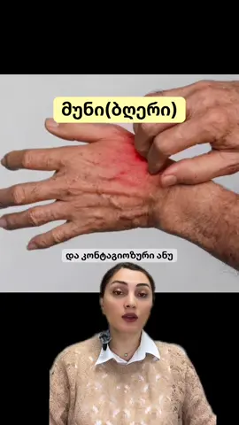 რა უნდა ვიცოდეთ მუნზე ანუ ბღერზე და როგორ ვმკურნალობთ მას?  #ფორიუზე #ფორიუ #შენთვის #ექიმი #მედიცინა 