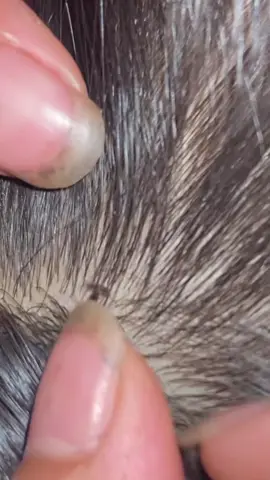😱😱😱#omg #lice #liceremoval 