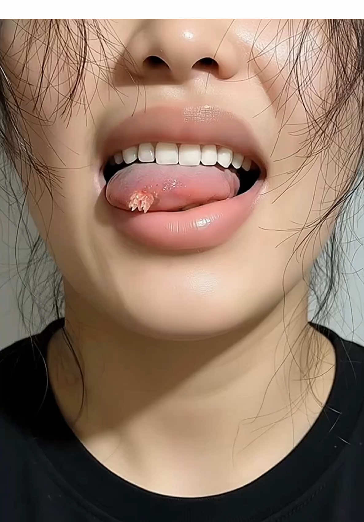 Em đội ơn mọi người. Nhờ mọi người nói rõ cho em biết cái mụn ở lưỡi như này là mụn gì, sao mà mỗi người nói một kiểu em thấy rối quá. #suckhoe #hỏivàtrảlời #suimaoga #dcgrbeauty #CapCut 