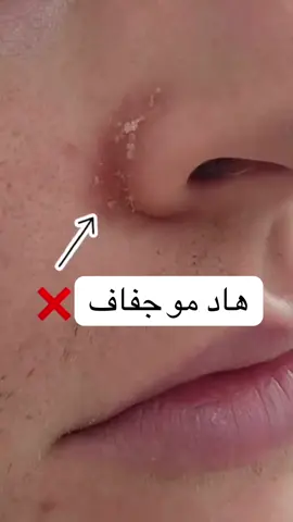 استخدام الزيوت او تجنب الفازلين والزيوت الثقيلة على الوجه يزيد من هالمرض شكل كبير حتى واقيات الشمس لازم ما تكون زيتية. 	.. ال كافيين وقت النوبات يزيد إفراز الدهون عند البعض .. اكل السكر والكربوهيدرات يزيد افراز الدهون على الوجه وكمان الوجبات مليانة دهون مشبعة (مثل الوجبات السريعة) كمان بتزيد هالشي