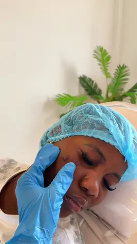 For all your skin concerns, call or WhatsApp 0558442988 Location: Ashongman Estate, Accra.  #keloid #keloidremoval #cryotherapy #accraghana🇬🇭 
