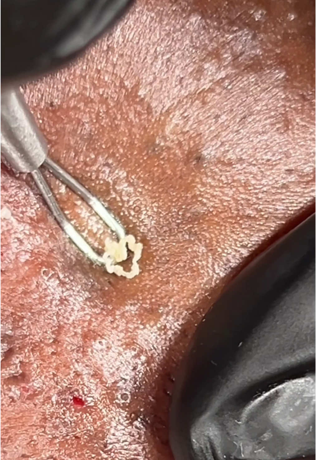 Shall I post more extraction videos? #satisfyingvideos #extractions #viral #faceextractions 