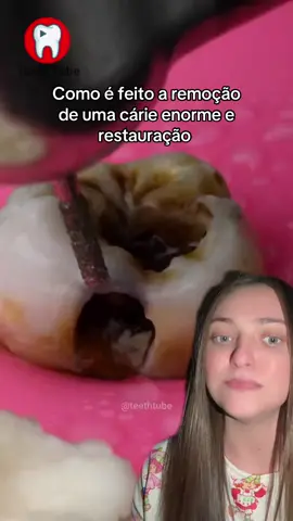 Como é feito a remoção de uma cárie enorme e restauração #restauracao #cariesdental #carie #dentista 