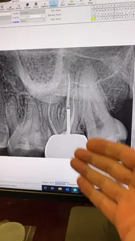 #dentists #dentalstudent #rootcanal #dentalhygienist #dentalofficelife 