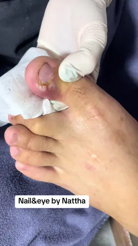 #ร้านเล็บสุพรรณบุรี #งัดเล็บขบ #เล็บขบbyNattha #เล็บขบ 