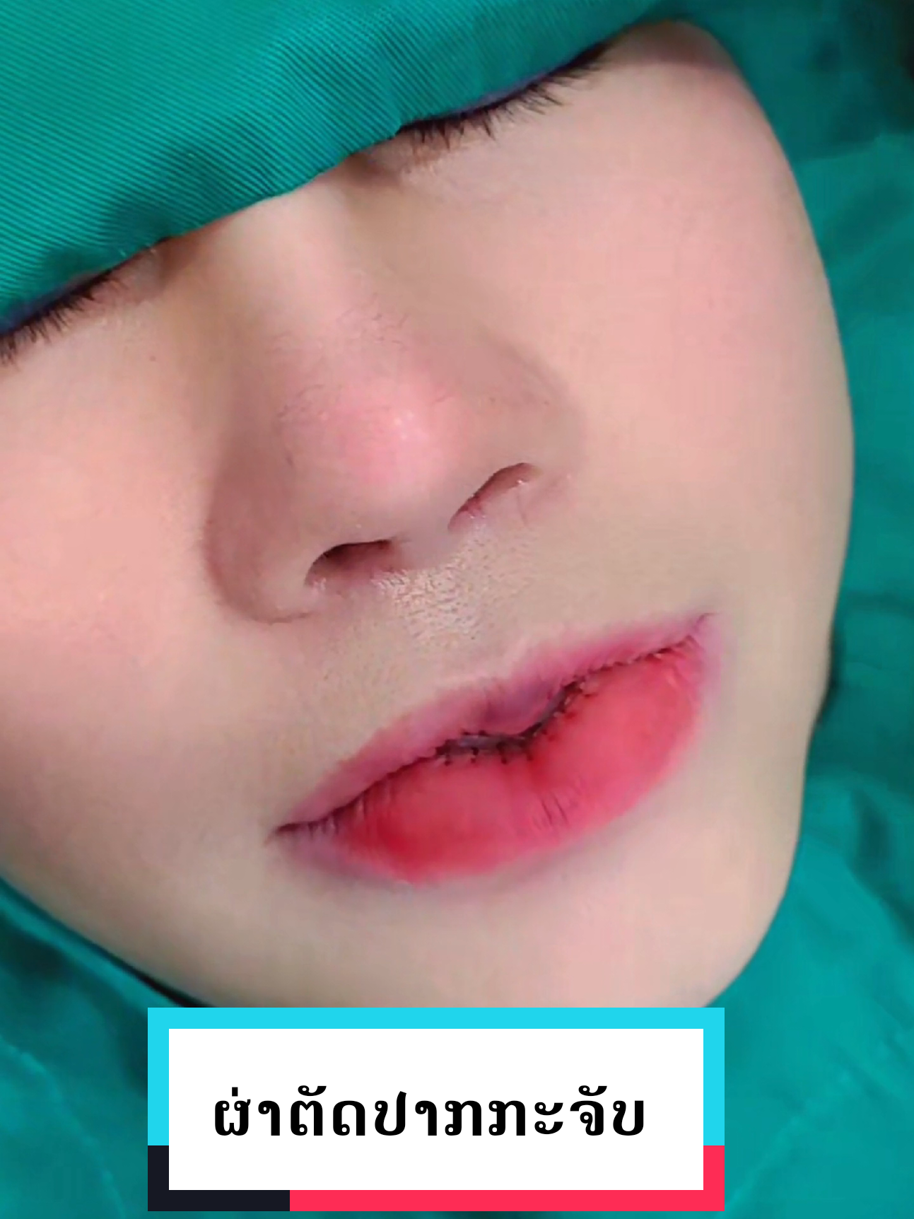 ຜ່າຕັດປາກກະຈັບ (ໃໝ Collagen).👄💋#ຜ່າຕັດປາກກະຈັບ #collagen #ສູນຄວາມງາມ #Dr  Tan
