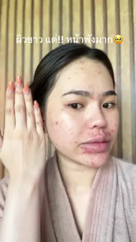 #ครีมหน้าพียาสกิน #เจ้าของแบรนด์โดสพียา #ลดสิวหน้าใส #ครีมบํารุงผิวหน้า #บอกต่อของดี 