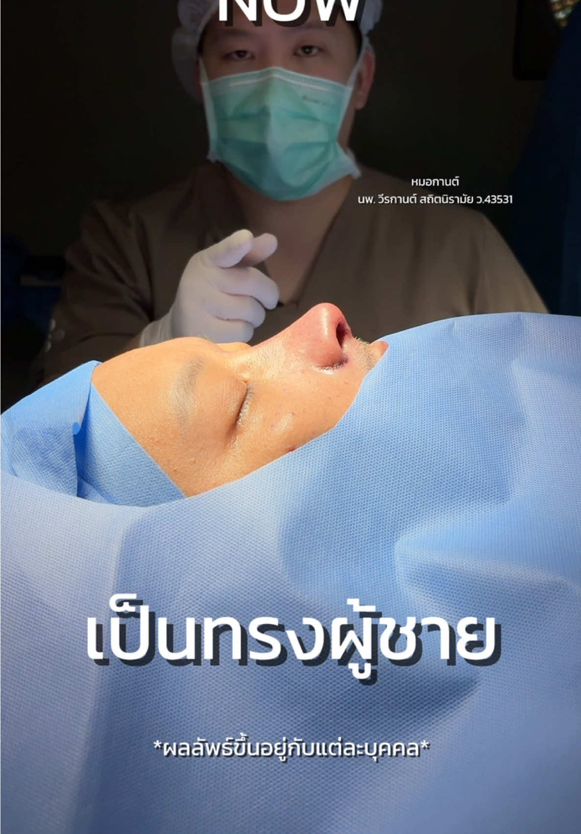 ครั้งแรกของการทำศัลยกรรม เคสนี้เป็นเคสเสริมใหม่ มีความเอียง ช่วงสัน มาแก้ไขใช้ซี่โครงตัวเองมาทำโครงสร้าง ทั้งสันและปลาย ทรงจมูกคม มีมิติขึ้น ปลายยาว #หมอวีรกานต์เมโกะ #หมอวีรกานต์meko #เสริมจมูกซี่โครงตัวเอง #mekohospital #ศัลยกรรม