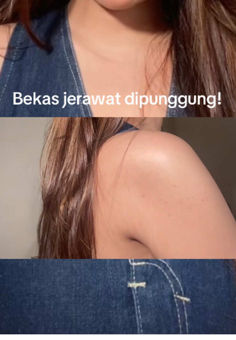 beneran bantu bngtt ngilangin jerawat + bekasnya di punggung aku! 🤍 #lotionacne #jerawatpungung #lotionviral #jerawat #fyppppppppppppppppppppppp 