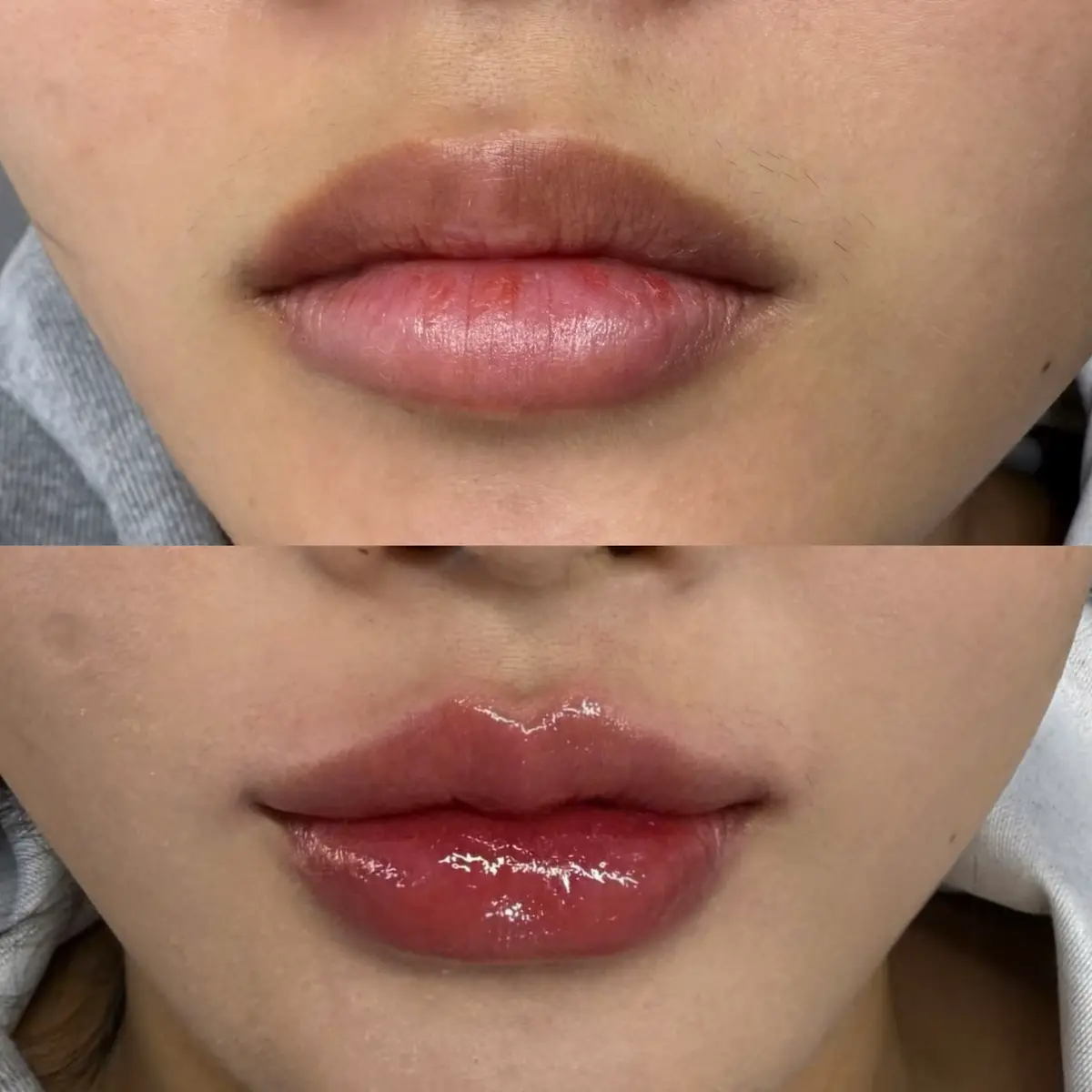 Môi 0,7 cc sẽ như thế nào😙#tiemmoidep #moibaby #xuhuong #trending #tiemmoi 