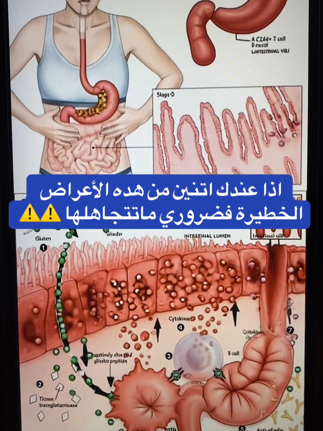 #قولون_تقرحي #قولون #إمساك_مزمن #إمساك #توعية_صحية #خمول #قولون_هضمي #إنتفاخ_البطن #إنتفاخ_القولون #قولون_معدة_غازات_إنتفاخات_إمساك_حموضة #الرياض_الان #السعودية_الكويت #إرتجاع_المرئ #إنتفاخ_البطن_والأمعاء #93saudinationalday #الرياض_الآن🇸🇦🇸🇦 #الرياض_جده_مكه_الدمام_المدينه #مكة_المكرمة_السعودية #الدمام