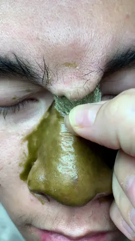 Nét lun #chamsocdamun#chamsocdaseo#chamsocdanam#tanbinh#Lqspa&academy