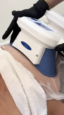 CRYOLIPOLYSE à seulement 50€ au lieu de 120€ !  Profitez de nos offres exceptionnelles pour la BLACK FRIDAY qui vous attend sur notre lien PLANITY ❤️ #cryolipolyse #bodyindustry #fyp #cryo #Laser 