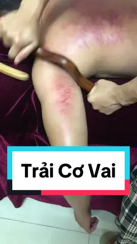 Cơ Bả Vai bị bó sâu, gây ra đau tức vùng bả vai, vận động khó khăn. Làm tê xuống cánh tay. #mocsaokhueyhct #masagetrilieu #masagefoot 