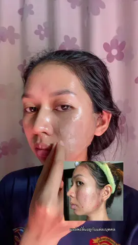 แปะไปก่อนเดี๋ยวจึ้งเอง ✅ #ส้มโอที่หน้าเป็นสิว #แผ่นแปะซิลิโคน #แผ่นแปะซิลิโคนเจล #ใช้ดีบอกต่อ #ป้ายยาtiktok 