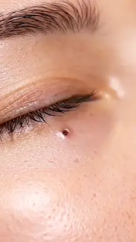 ASMR video #tiktokusa🇺🇸 #asmrvideo #asmrsounds #blackheadremoval #viraltiktok 