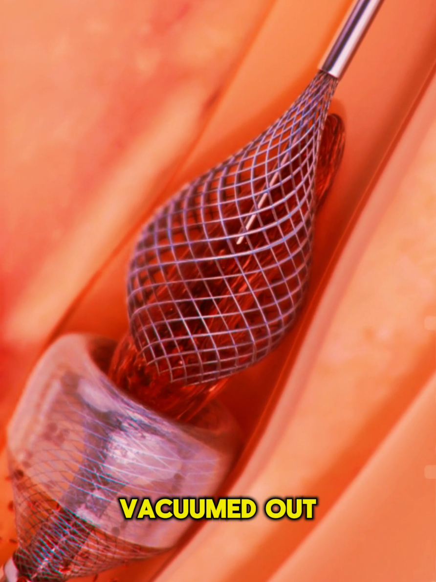 How MegaVac Thrombectomy is Performed? (3D Animation) #how #mega #vac #bloodclots #3danimation 