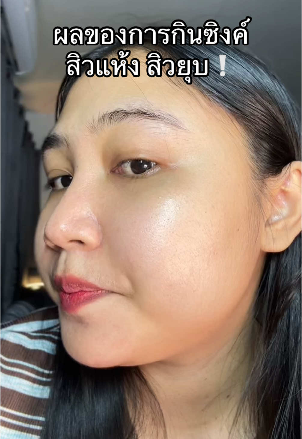 คือมันเริ่ดดดเลยล่ะ #ซิงค์ลดสิว #ซิงค์พลัสวิตามินซี #ซิงค์เมดิต้า 