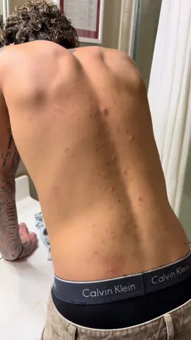 Use this for any back acne or body acne and it’ll help  #acnecontrol #acnetreatment #backne #bodyacne #acnecream 