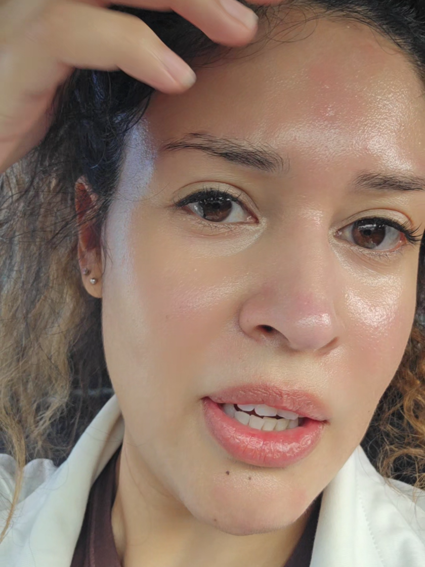 I literally used to think mosquitoes were attracted to my sweat😂  #allergies #hives #workout #sensitiveskin #fyp 