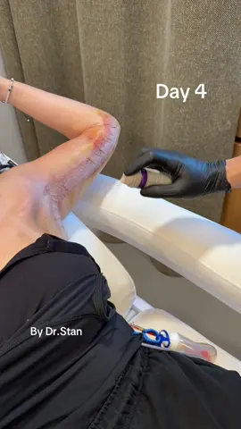 Dressing change day 4 after arm lift #armlift #tape #fyp #skinremoval #tiktok 