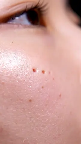 “Most Satisfying Blackhead Vacuum Extraction Ever! Real Deep Pore Cleaning ASMR for Stress Relief,