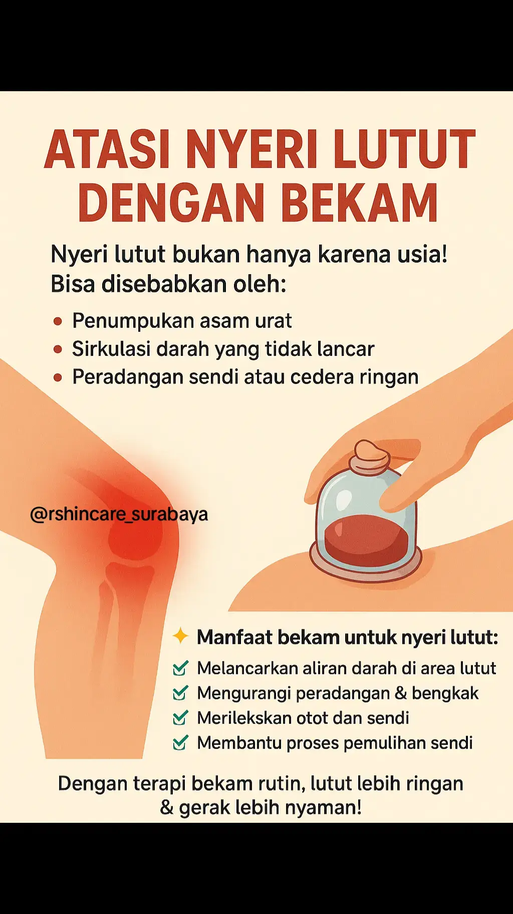 Lutut sering nyeri atau kaku? Coba terapi bekam, membantu melancarkan aliran darah dan meredakan nyeri agar langkahmu kembali ringan🤩 #bekam #bekamsunnah #terapialami #bekamsurabaya #fyp 
