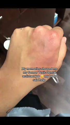 Dam I still don’t know how I survived that job 😮‍💨 so stressful that my body would react with inflammation #dentalassistant #dental #teethtok 