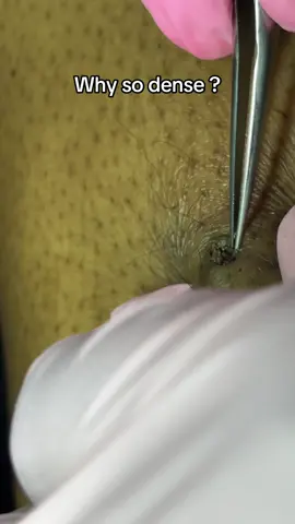 I wanna see some ingrown pictures in the comment section 👀👀👀 #galaxyextraction #ingrownhairremoval #extractionsatisfaciton 