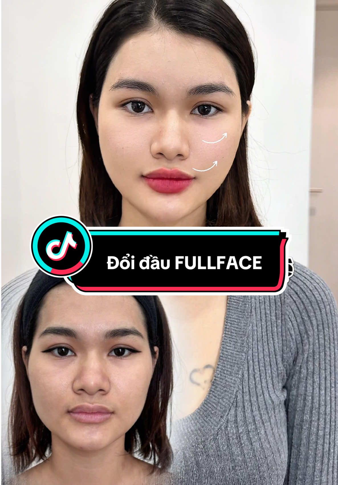 Thay đầu chỉ trong vài chục phút , thay đổi bất ngờ 🤭  #phamhailinh #bacsitiemmoidep #daytiemfiller #tiemfiiler #fullface 