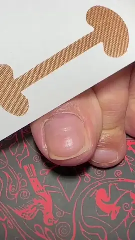 Product Link in Bio The Toe Align Ingrown Nail Corrector Stickers gently guide nail growth to prevent pain and pressure. A simple, effective solution for healthier, more comfortable nails. Product: Toe Align Ingrown Nail Corrector Stickers 1️⃣ no copyright intended. DM for inquiries. ingrown nail treatment, nail corrector, toe care, foot health, nail pain relief, pedicure care, toe alignment, nail repair stickers, self-care tools, foot care accessories