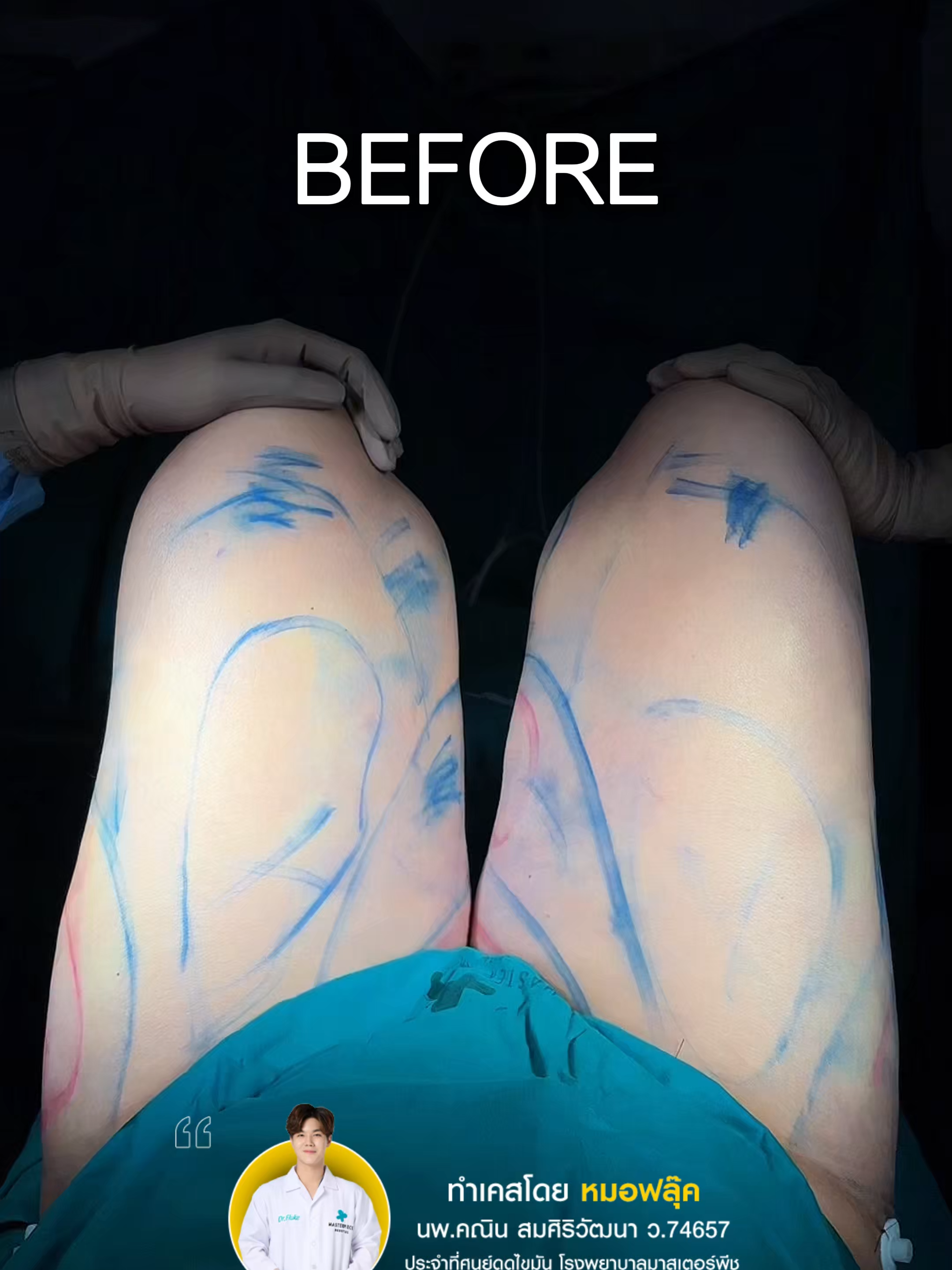 หลังทำทันที ดูดไขมันทั้งตัว โดย #หมอฟลุ๊คmasterpiece สวย จึ้ง ขนาดไหน มาดูกัน#หมอหล่อบอกต่อด้วย #fypシ゚ #liposuction #masterpiecehospital #ดูดไขมัน