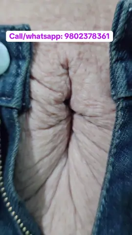 #stitch #scar #viralvideo #stretchmarks #foryou 