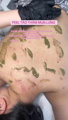 Mùa đông – thời điểm vàng để peel thâm mun lưng #mayspa #peel_lưng #trị_thâm_mụn_lưng #trị_mụn_chuẩn_y_khoa 