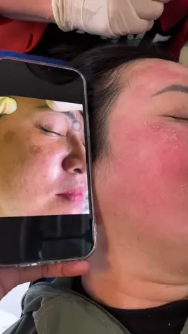 đánh bay tàn nhang đốm nâu sau 3 tuần#hashtaglenxuhuong 