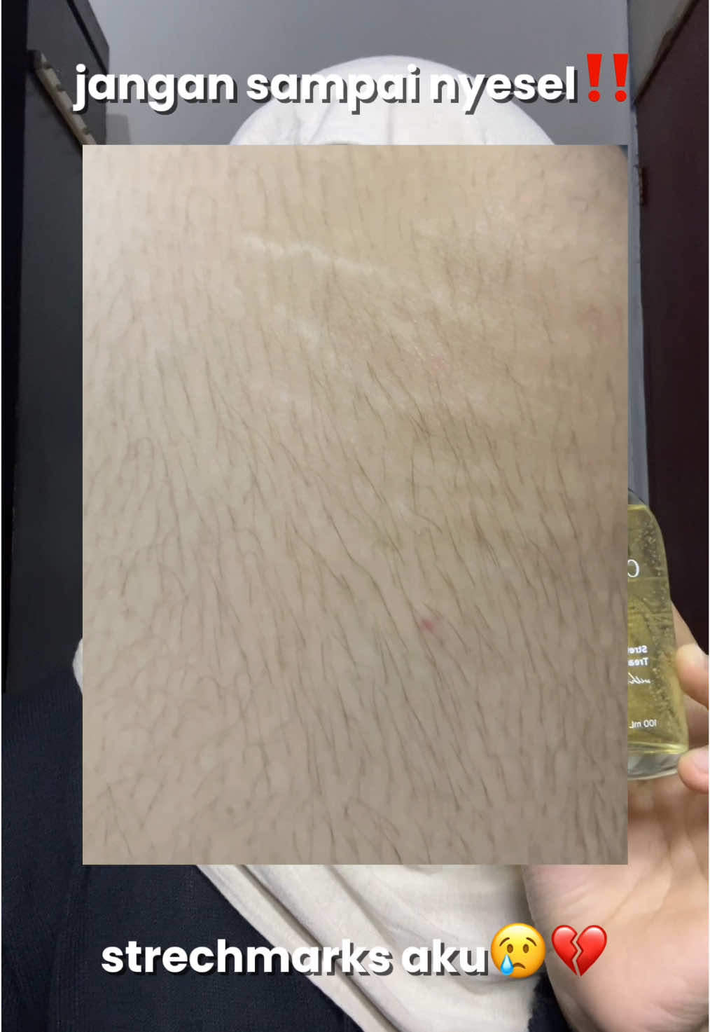 ayo pake ini sebelum makin parah guys 🥹🫂 #strechmarks #strechmark #strechmarkserum #strechmarkoil #ciaraindonesia 