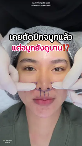 เคยตัดปีกจมูกแล้ว แต่จมูกยังบาน ⁉️ #ทีมแพทย์fernclinic #ตัดปีกจมูก #ศัลยกรรม #FernClinic #tiktokviral 