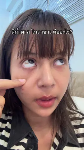 #ตาขาว #ปานตาขาว 