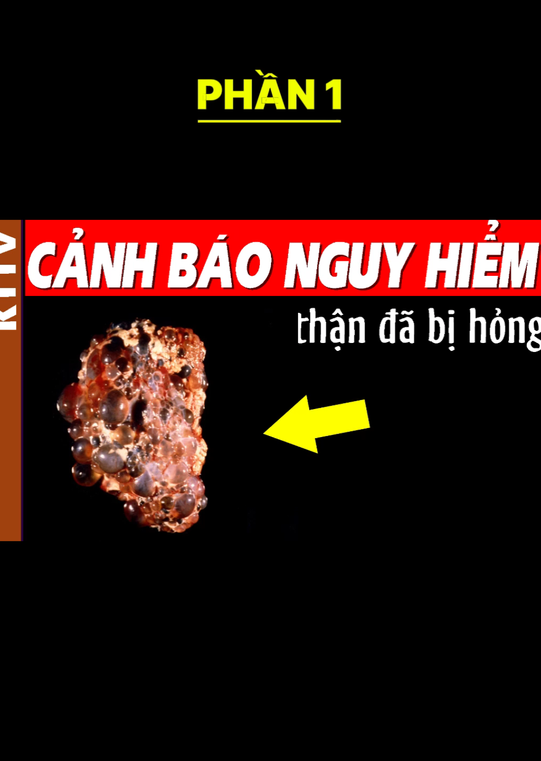 Nếu có 9 dấu hiệu này, phải đi khám Thận Ngay Lập Tức!. Phần 1 #than #dauhieuthanhong #dauhieu #khambenh #benhthan 