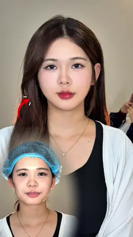 Baby face cho e khách 2k7#filler #botox #thuthuybeauty 